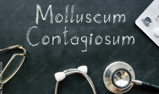 Comprendre et traiter le molluscum contagiosum