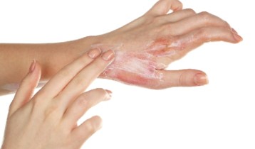 Brûlures du premier et second degré : comment réagir ?