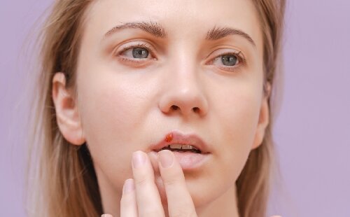 Tout savoir sur le bouton de fièvre : causes, symptômes et traitements