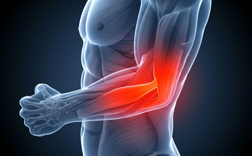 Comprendre et traiter l'épicondylite ou tennis elbow