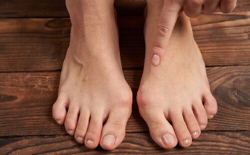 Comprendre et traiter l'hallux valgus : de la déformation aux solutions correctrices
