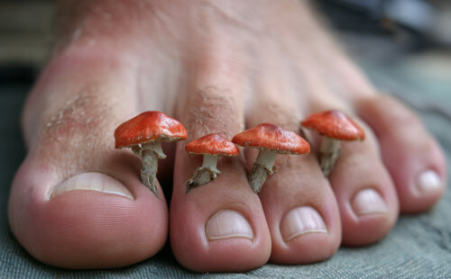Mycoses des pieds et pieds d'athlète : comprendre, traiter et prévenir