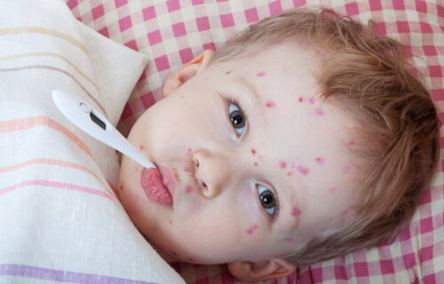 Varicelle : causes, symptômes et traitements
