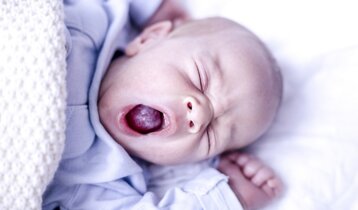 Comment soigner le muguet buccal de bébé ?