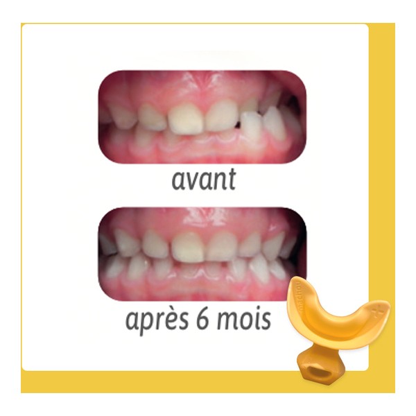 Machou+ gouttière dentaire