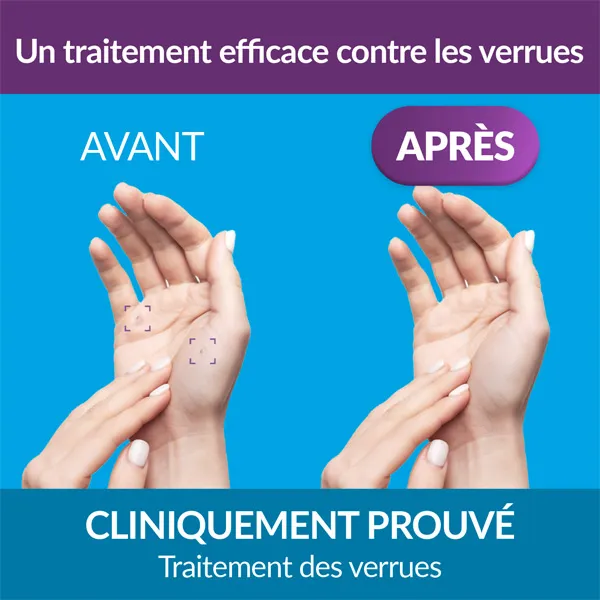 Excilor Verrue traitement par cryothérapie
