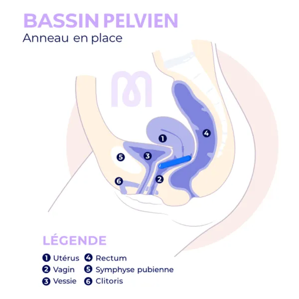 Pessaire Anneau Dr Arabin