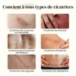 Dermatix gel silicone cicatrice