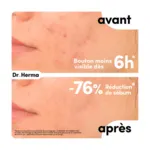Dr Herma Patch anti boutons​ format Large