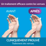 Excilor Verrue traitement par cryothérapie