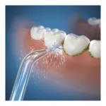 Embout pour hydropulseur Waterpik