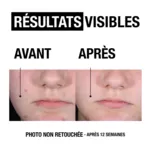 Neutrogena Anti-boutons+ Gel Hydratant visage