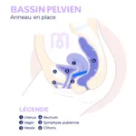 Pessaire Anneau Dr Arabin