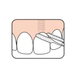 TePe Fil dentaire bridge et implant